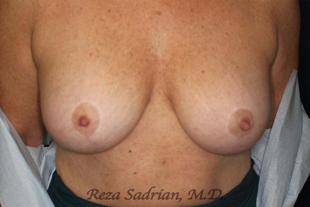 Breast Revision Before & After Image