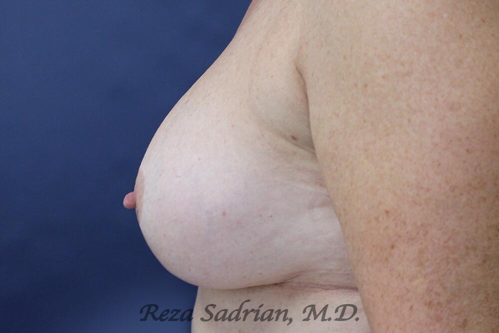 Breast Revision Before & After Image