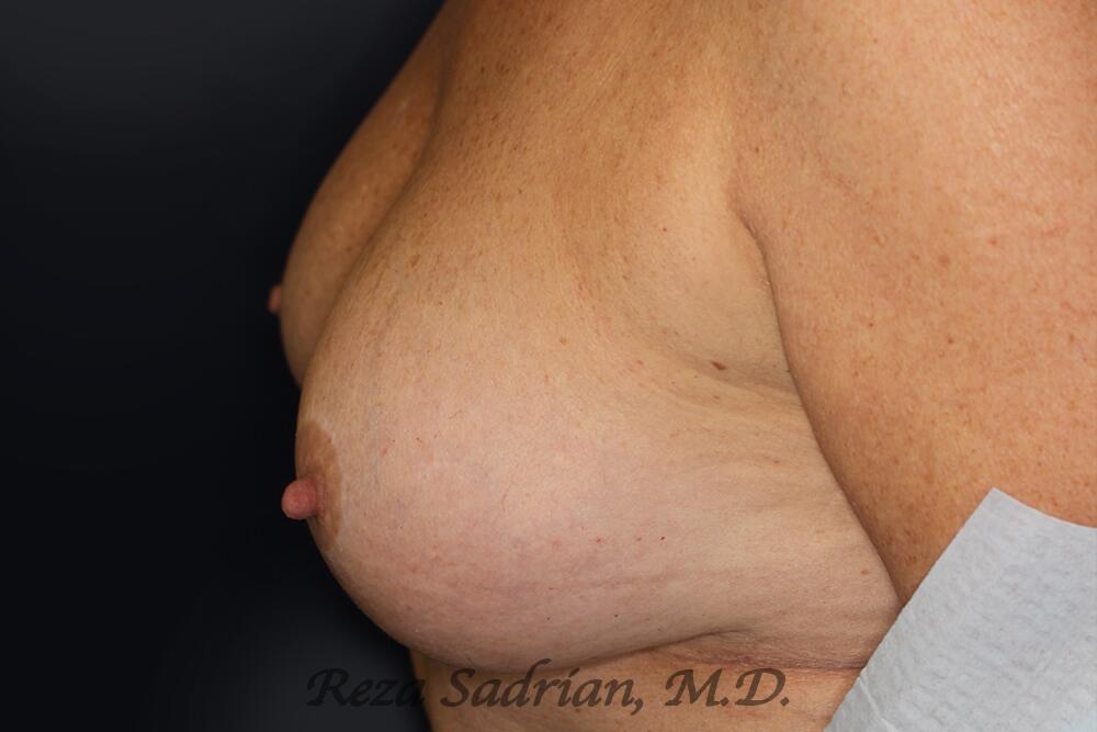 Breast Revision Before & After Image