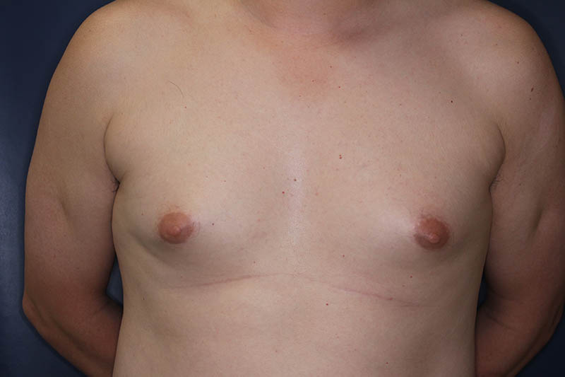 Gynecomastia Before & After Image