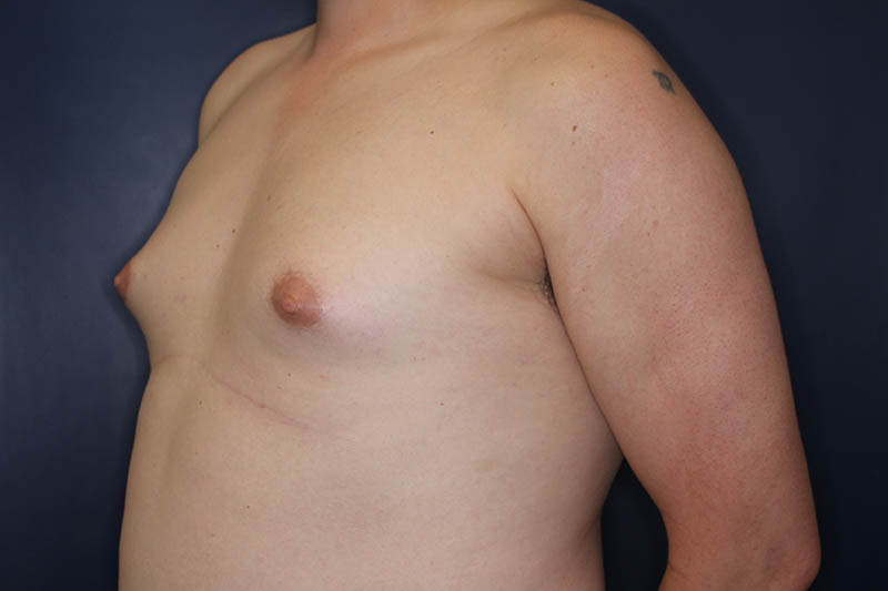 Gynecomastia Before & After Image