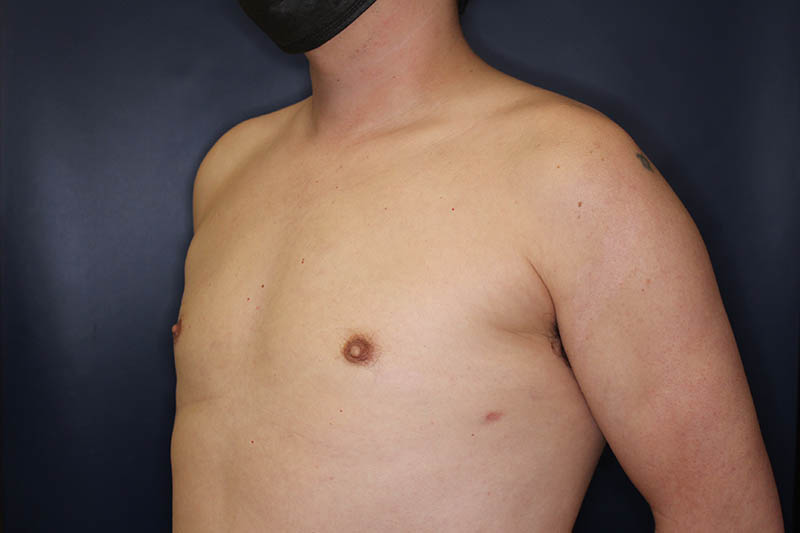 Gynecomastia Before & After Image