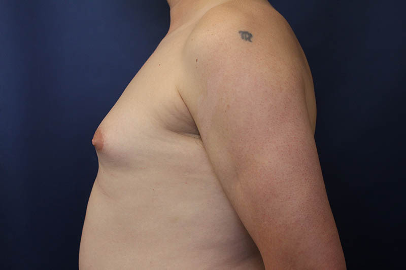 Gynecomastia Before & After Image