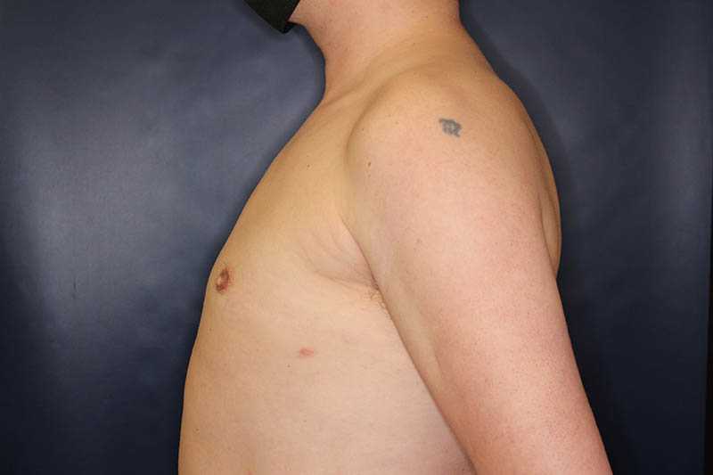 Gynecomastia Before & After Image