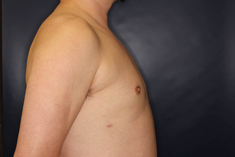 Gynecomastia Before & After Image