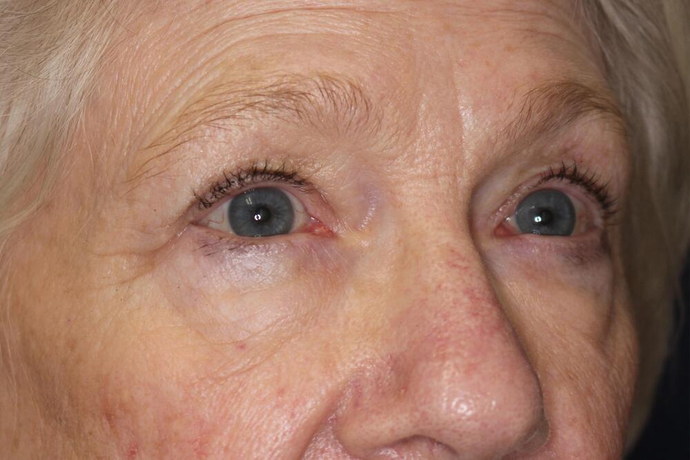 Blepharoplasty Before & After Image