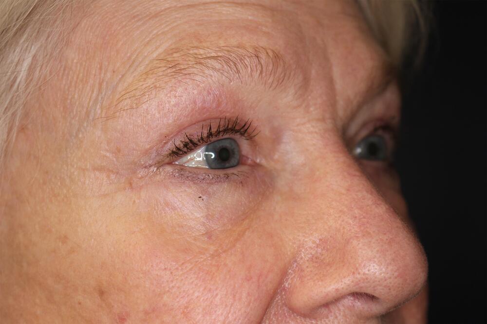 Blepharoplasty Before & After Image