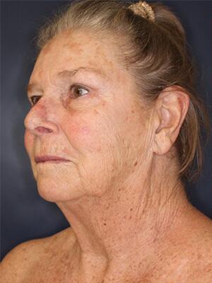 Blepharoplasty Before & After Image