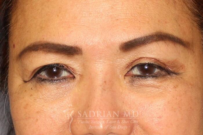 Blepharoplasty Before & After Image