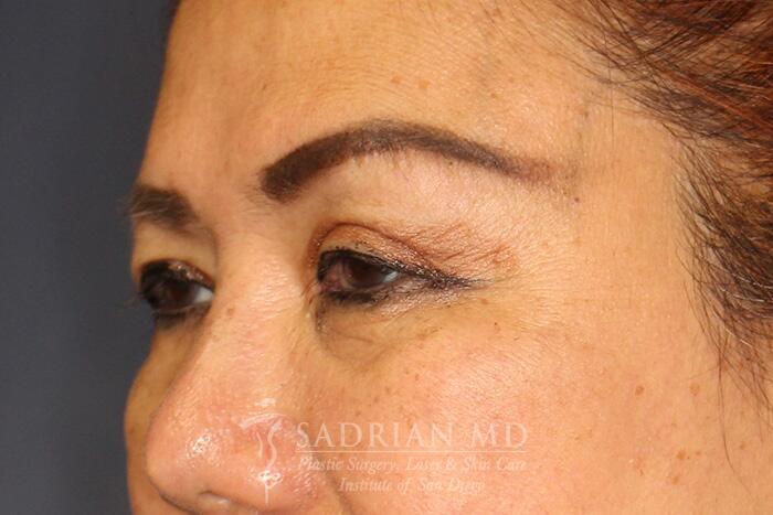 Blepharoplasty Before & After Image