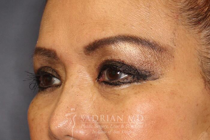 Blepharoplasty Before & After Image