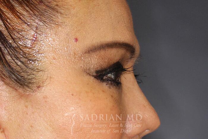 Blepharoplasty Before & After Image