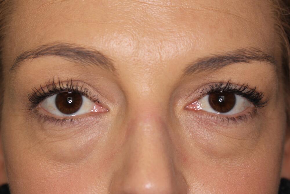 Blepharoplasty Before & After Image