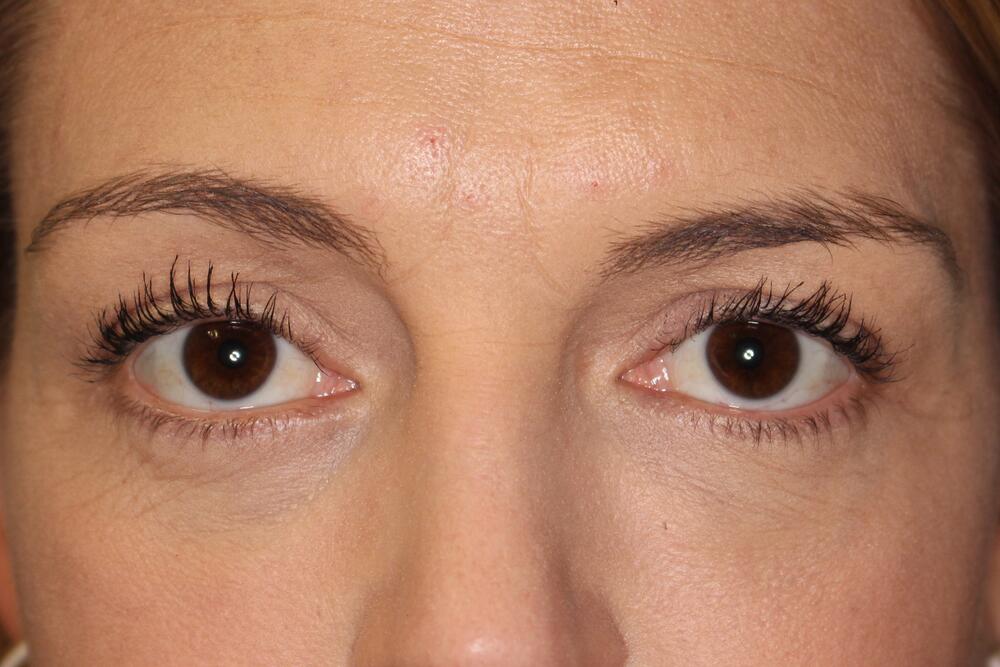 Blepharoplasty Before & After Image