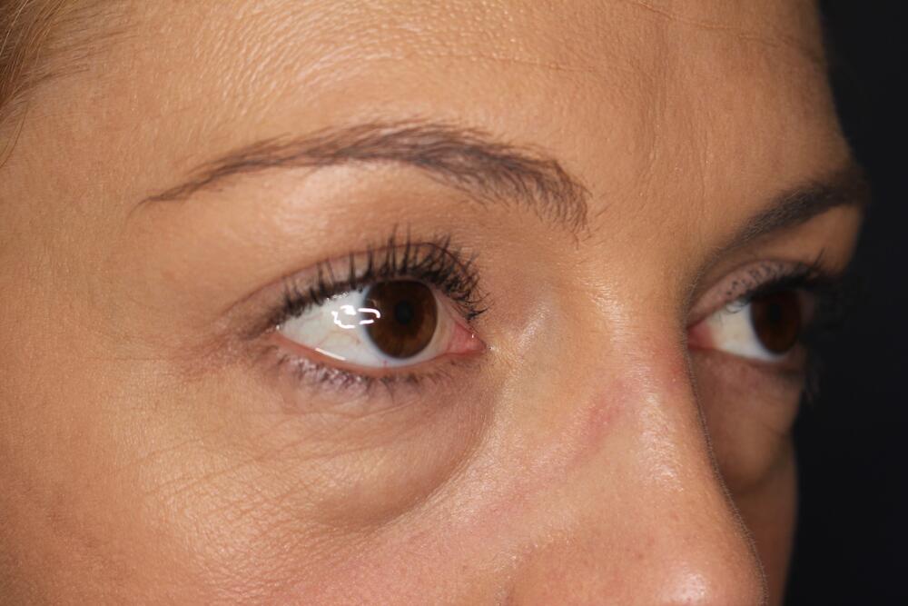 Blepharoplasty Before & After Image