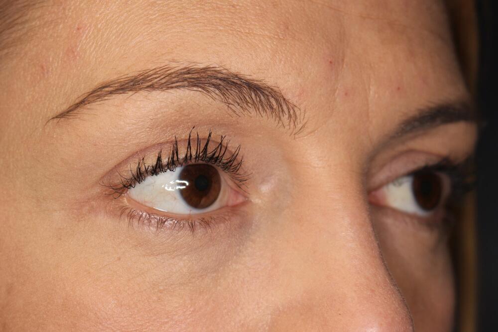 Blepharoplasty Before & After Image