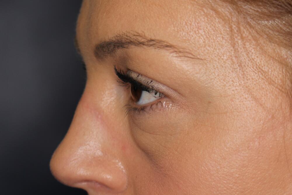 Blepharoplasty Before & After Image