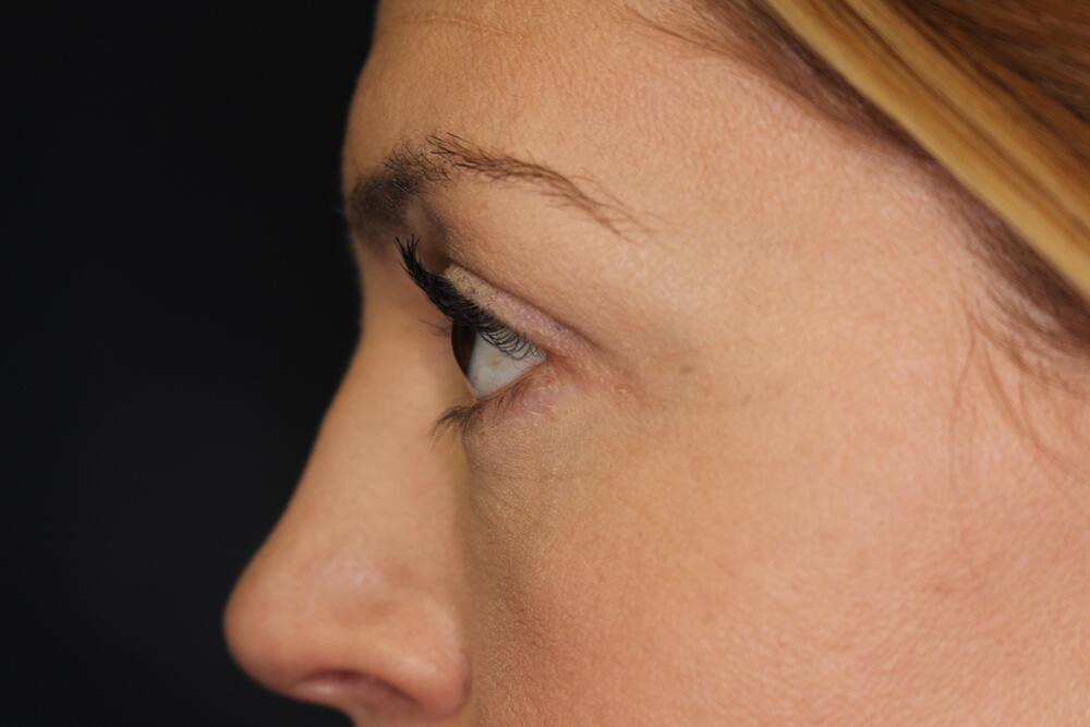 Blepharoplasty Before & After Image