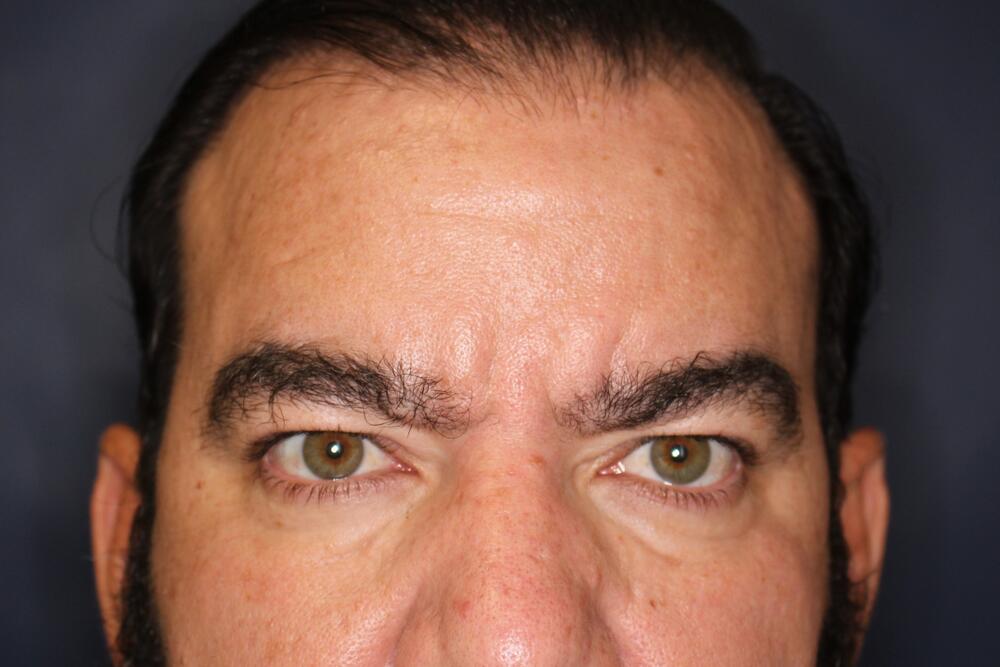 Blepharoplasty Before & After Image