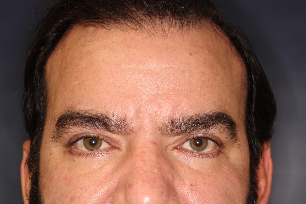 Blepharoplasty Before & After Image