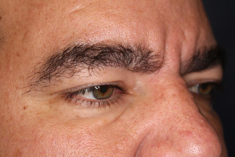 Blepharoplasty Before & After Image