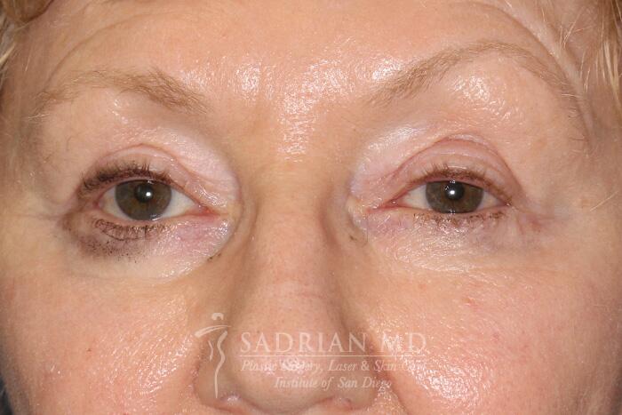 Blepharoplasty Before & After Image