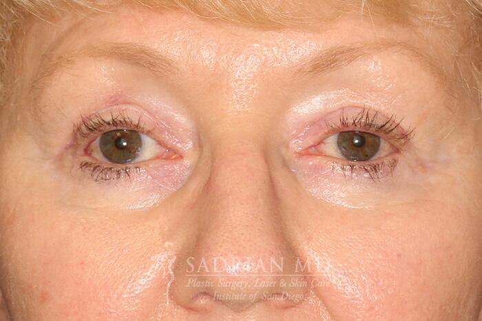 Blepharoplasty Before & After Image