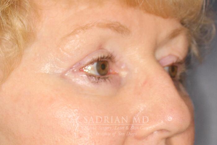 Blepharoplasty Before & After Image