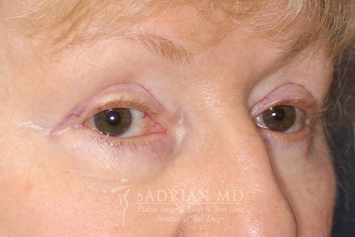 Blepharoplasty Before & After Image