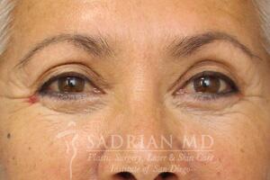 Blepharoplasty Before & After Image