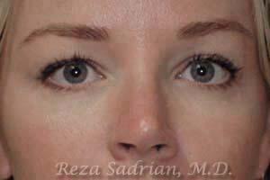 Blepharoplasty Before & After Image