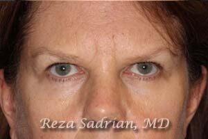 Blepharoplasty Before & After Image