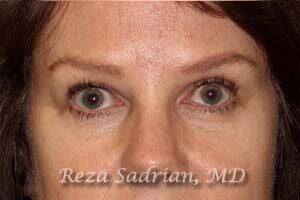 Blepharoplasty Before & After Image