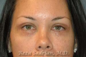 Blepharoplasty Before & After Image