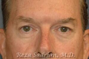 Blepharoplasty Before & After Image