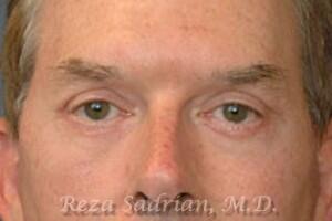 Blepharoplasty Before & After Image