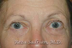 Blepharoplasty Before & After Image