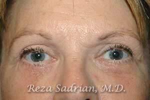 Blepharoplasty Before & After Image