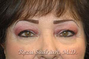 Blepharoplasty Before & After Image