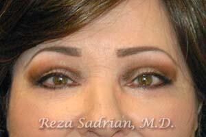 Blepharoplasty Before & After Image