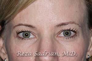 Blepharoplasty Before & After Image