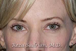 Blepharoplasty Before & After Image