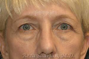 Blepharoplasty Before & After Image