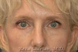 Blepharoplasty Before & After Image