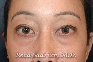 Blepharoplasty Before & After Image