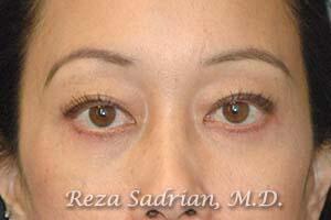 Blepharoplasty Before & After Image