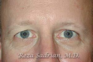 Blepharoplasty Before & After Image