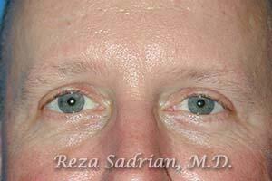 Blepharoplasty Before & After Image