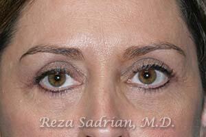 Blepharoplasty Before & After Image