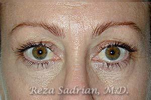 Blepharoplasty Before & After Image